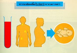 ทารกติดเชื้อไวรัสจากมารดา