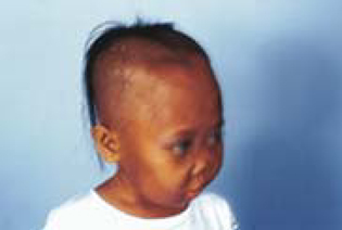 ธาลัสซีเมีย