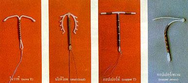 ห่วงคุมกำเนิดแบบใหม่ชนิดต่าง ๆ