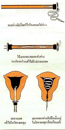 แผนภาพแสดงการใส่ห่วงลิปพีส