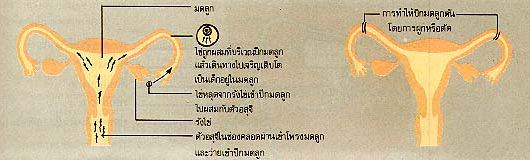 แผนภาพแสดงวิธีการทำหมันหญิง